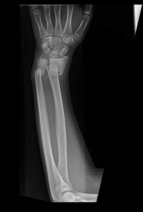 X Rays Of Broken Arms