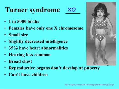 Xo Chromosome Abnormality