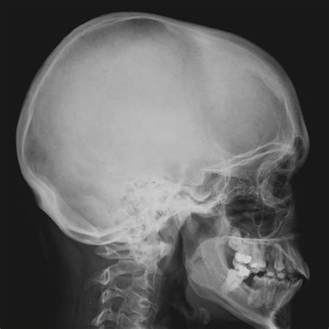 Xray Skull Lateral View