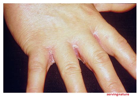 Yeast Infection Of The Hands And Feet