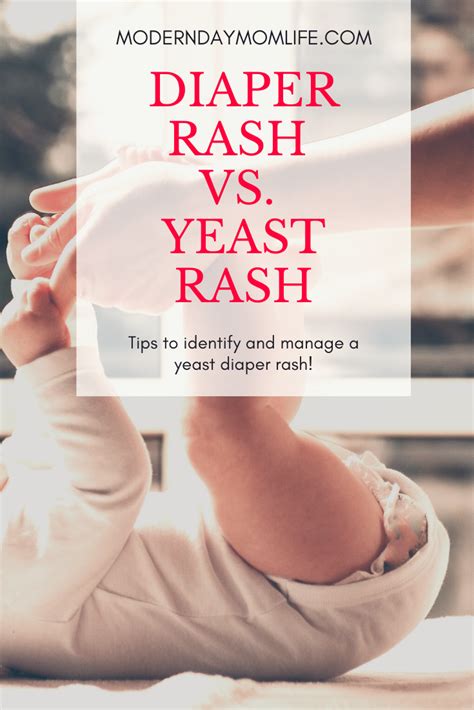 Yeast Vs Regular Diaper Rash