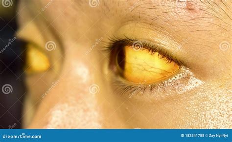 yellow colored sclera