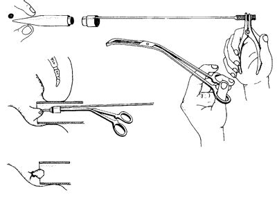 yttre hemorrojder gummiband
