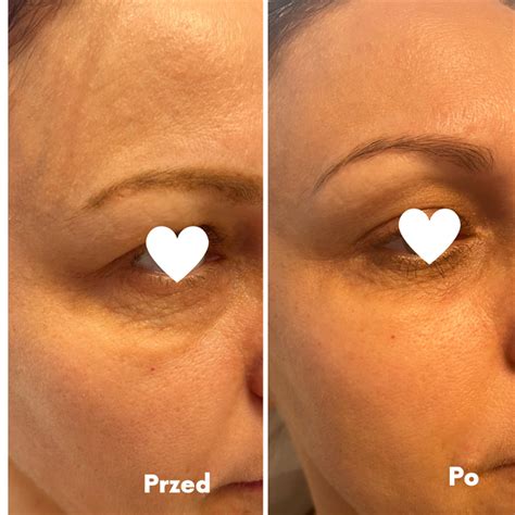 zabieg na oczy