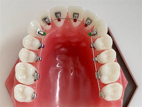 zahnspange von innen