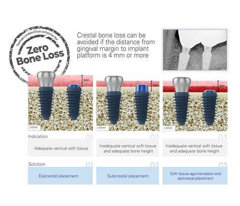 zero bone loss concepts