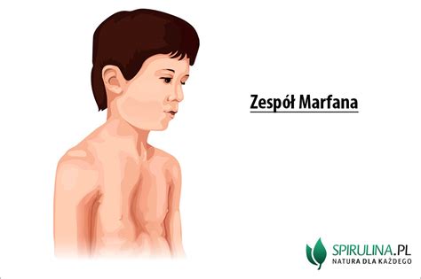 Zespół Marfana Twarz