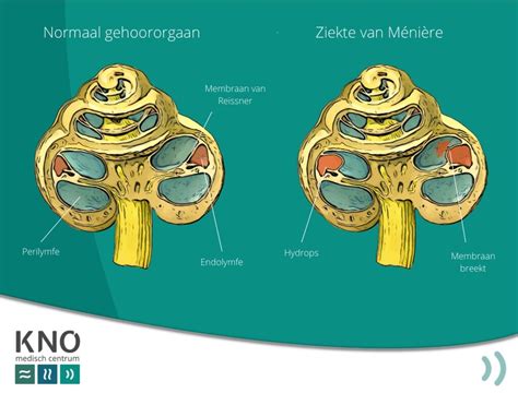 ziekte van meniere invaliditeit