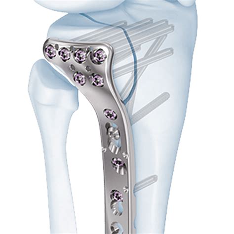 Download Zimmer Periarticular Proximal Tibial Locking Plate 