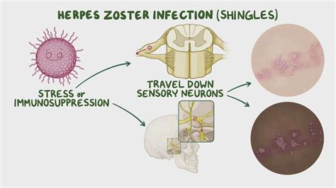 Zoster Sine Herpete