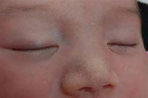 婴儿脸上有小白点是什么