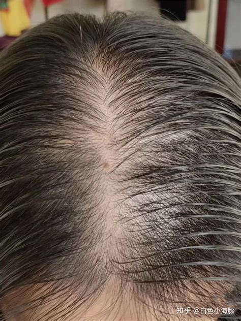 脂溢性脱发的生发方法