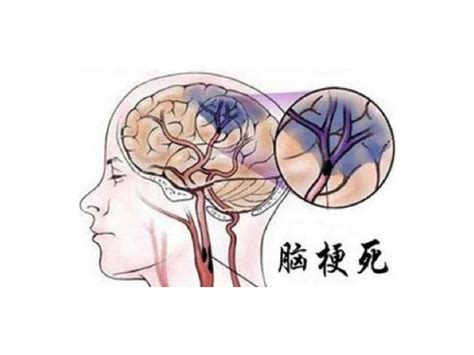 脑梗的表现是什么症状