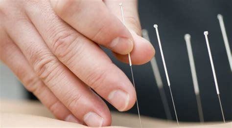 ﻿comment devenir acupuncteur